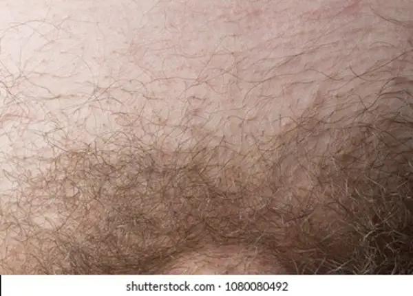 Pubic Hair Loss in Men