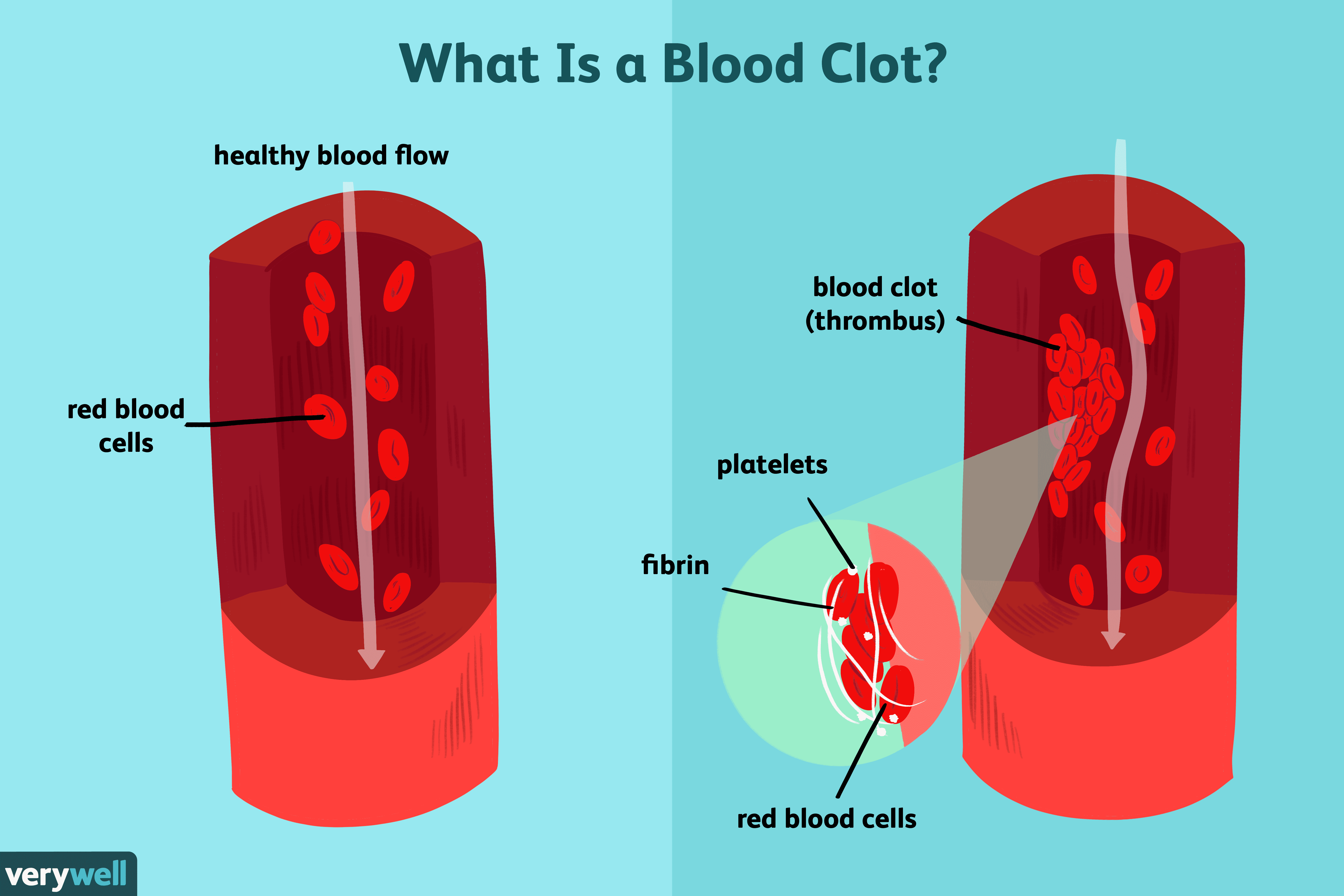 can blood clots make your blood pressure go up