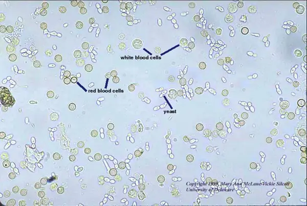 Signs of White Blood Cells in Urine