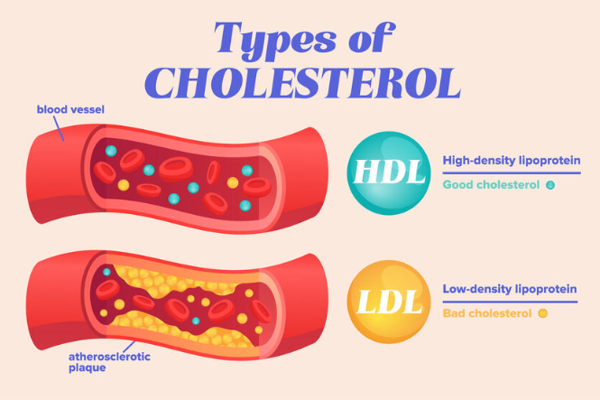 High VLDL Cholesterol Levels