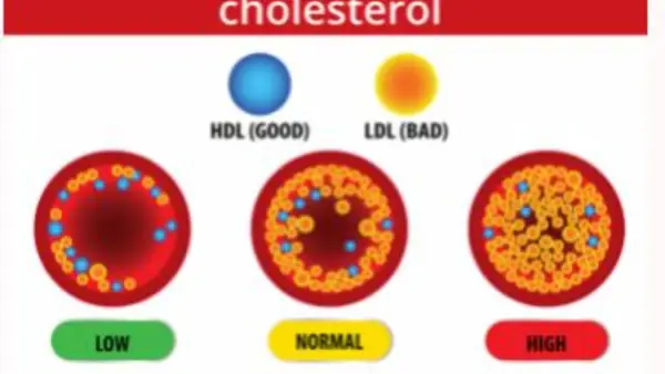 Treatment Options for High VLDL Cholesterol