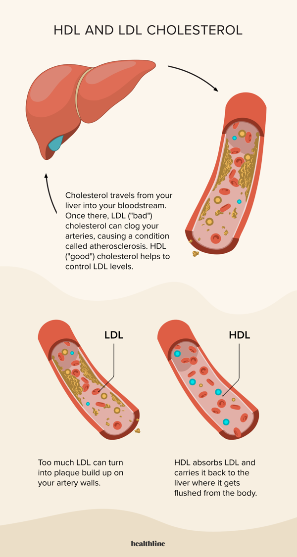 The Connection Between LDL Cholesterol and Diabetes