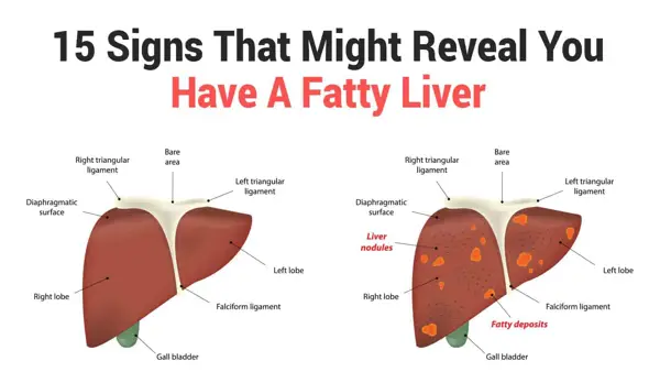 Common Symptoms of Liver Problems