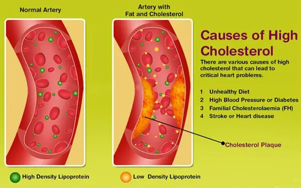 Treatment Options for Liver-Related High Cholesterol