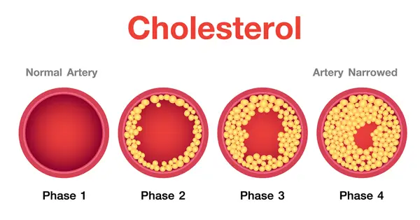 Effects of High Cholesterol on the Heart