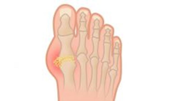 Prevention Tips for Gout