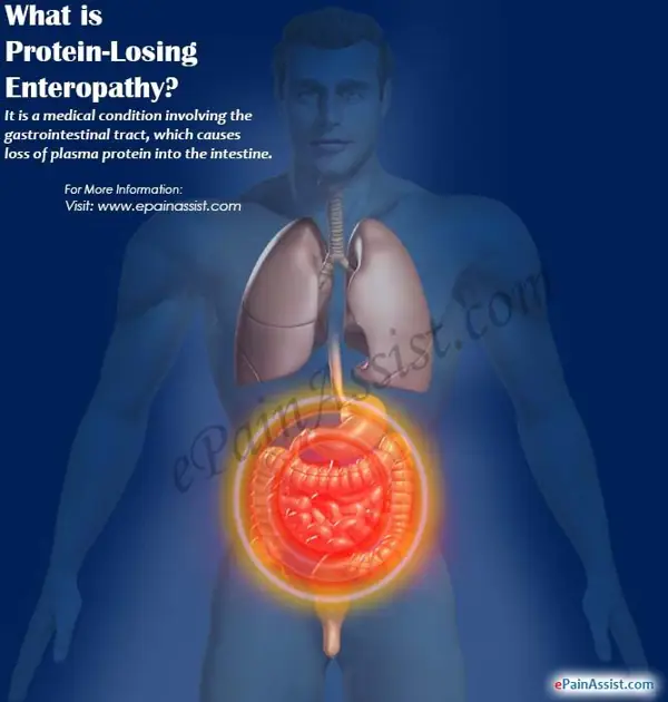 Diagnosis of Protein Loss Enteropathy
