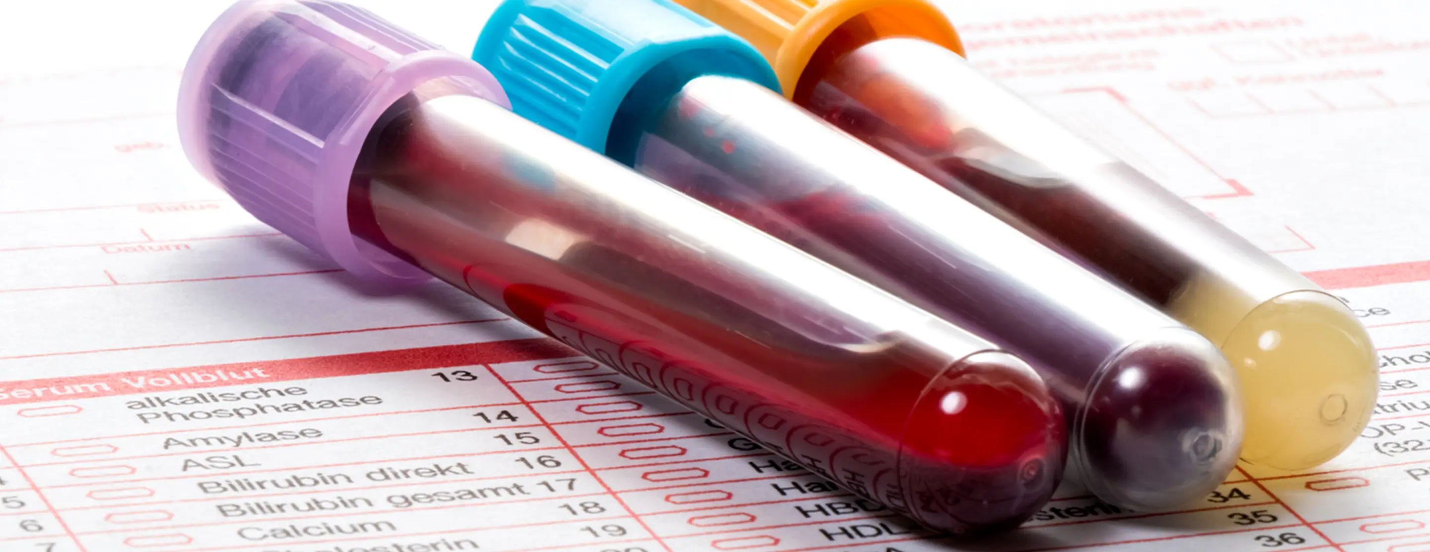 high serum total protein levels in blood test