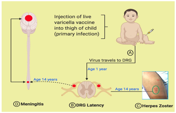 varicella zoster virus meningitis